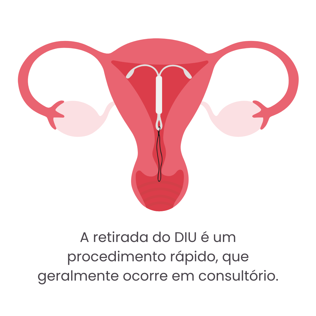 Deseja retirar o DIU? O que esperar e como se preparar?
